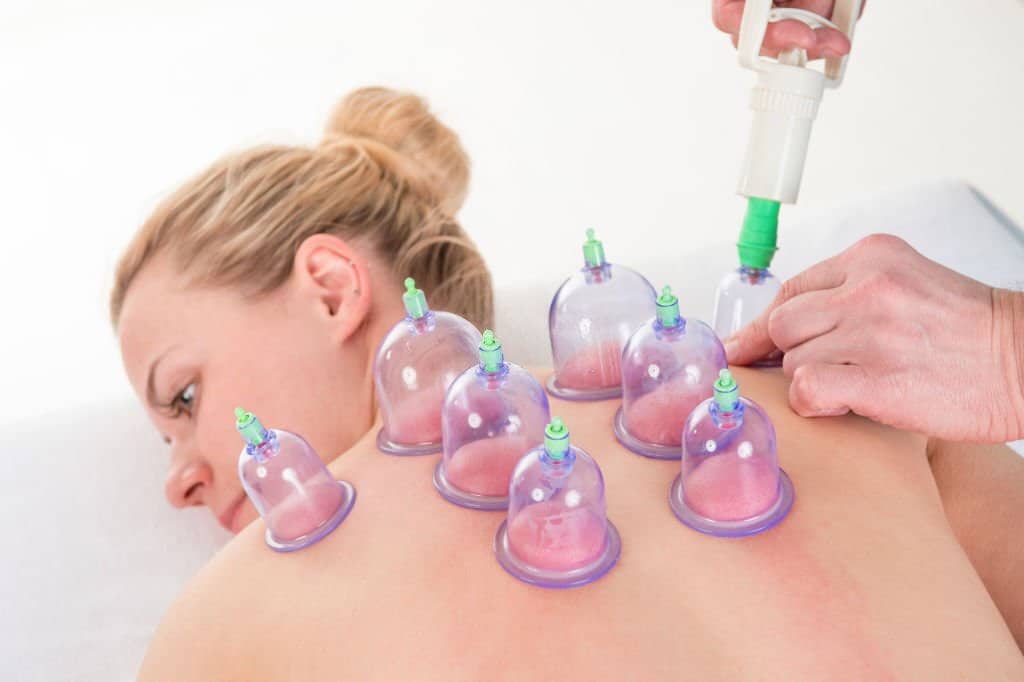 corso cupping therapy