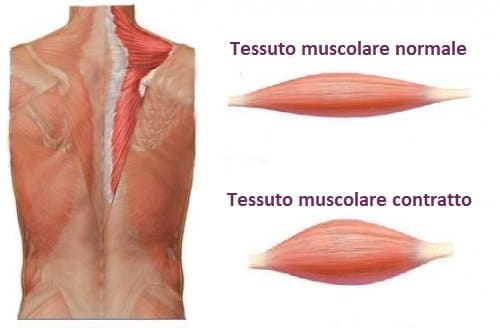 La contatterà muscolare