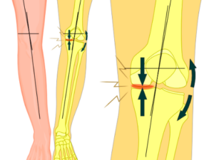 Cos’è il ginocchio varo?